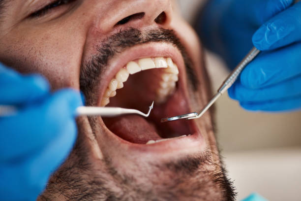 Best Emergency Wisdom Tooth Extraction in Minerva Park, OH