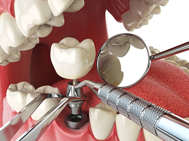 Best Lost Filling or Crown Replacement in Minerva Park, OH